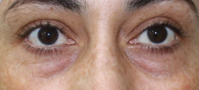 درمان سیاهی دور چشم چیست
